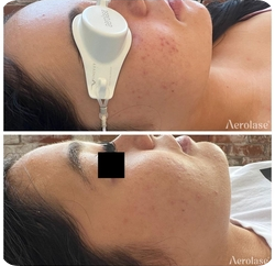 Aerolase® Neo Elite Laser